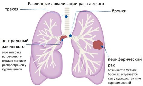 Симптомы инфильтрата правого легкого