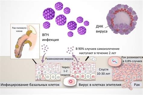 Симптомы и диагностика ВПЧ эффекта