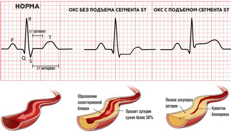 Симптомы и диагностика коронарного заболевания