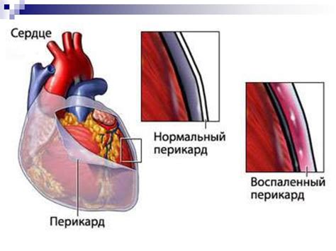 Симптомы и диагностика перикардита