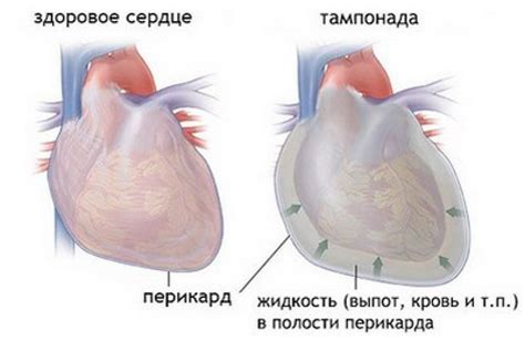 Симптомы и диагностика тугой тампонады