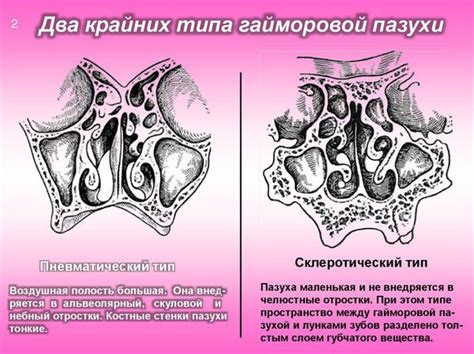 Симптомы и диагностика утолщения слизистой верхнечелюстной пазухи