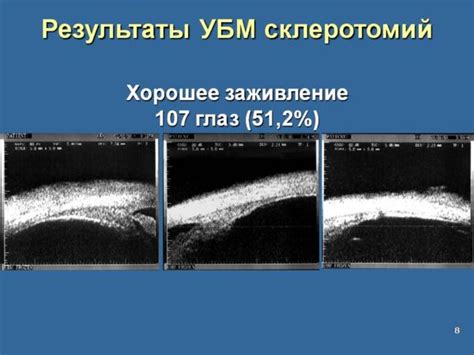 Симптомы и категории врастания