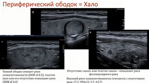 Симптомы и признаки гипоэхогенного ободка