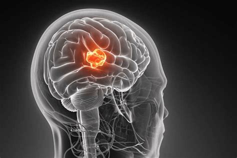 Симптомы и признаки злокачественной опухоли головного мозга