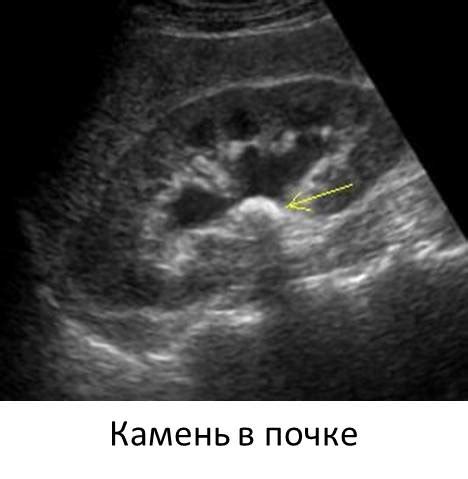 Симптомы и признаки невидимости надпочечников при УЗИ