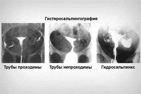 Симптомы и признаки пробоя маточных труб