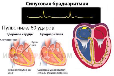 Симптомы и признаки синусовой брадиаритмии у ребенка