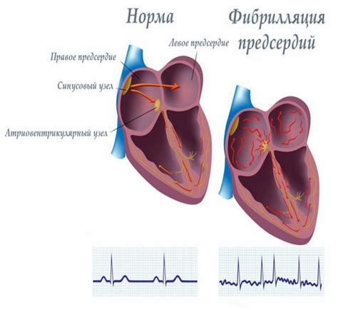 Симптомы и признаки увеличения предсердий