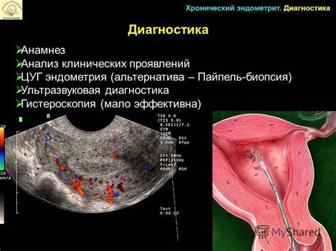 Симптомы и причины развития эндометриоза