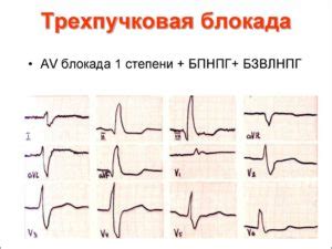 Симптомы и проявления полной предсердно-желудочковой блокады