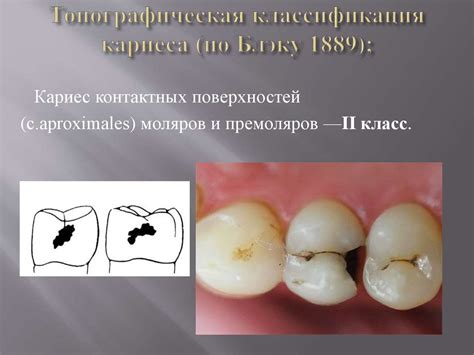 Симптомы кариозных зубов