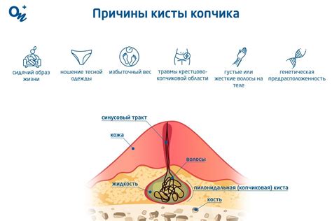 Симптомы кисты копчика