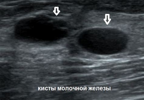 Симптомы кисты молочной железы с кровотоком