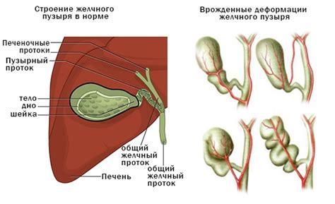 Симптомы лабильного перегиба желчного пузыря