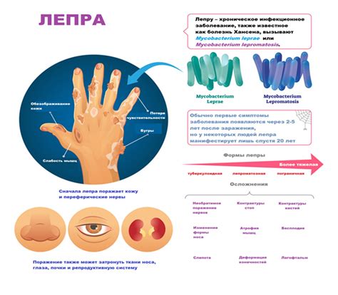 Симптомы лепры