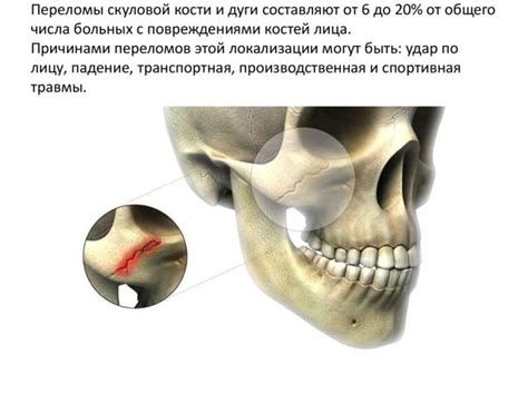 Симптомы линейного перелома