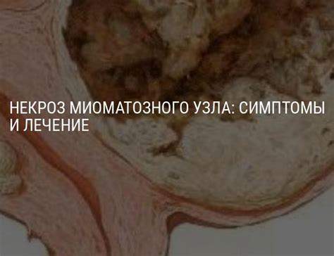 Симптомы миоматозного узла и его последствия