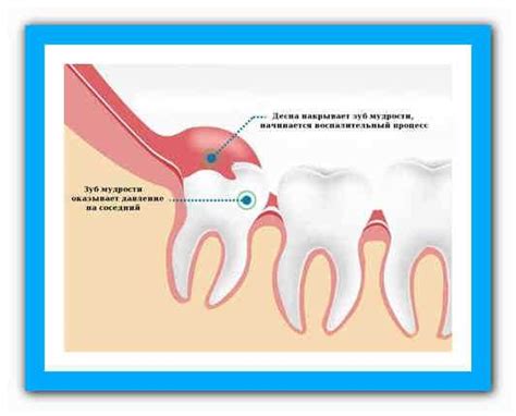 Симптомы нароста на зубе