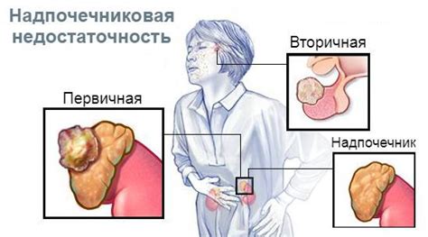 Симптомы недостаточности пилоруса