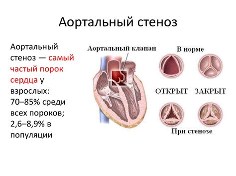 Симптомы незначительного стеноза аортального клапана