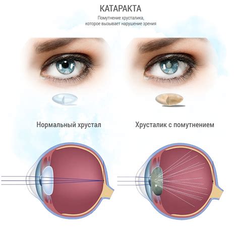 Симптомы незрелой катаракты обоих глаз