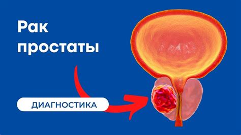 Симптомы неопластического процесса предстательной железы