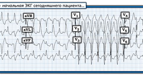 Симптомы неправильного ритма QRS