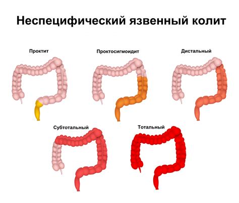 Симптомы неспецифического язвенного колита