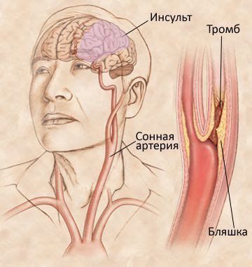 Симптомы окклюзии ПБА