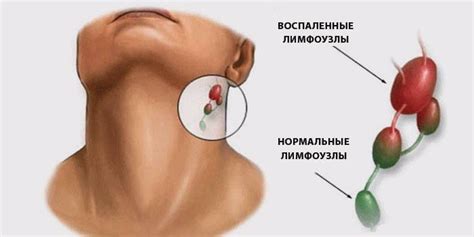 Симптомы опухшего лимфоузла