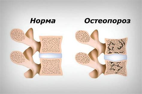 Симптомы остеопороза