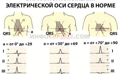 Симптомы отклонения оси сердца влево у мужчин