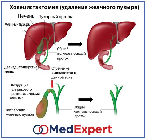 Симптомы перегиба тела желчного пузыря