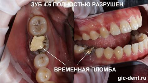 Симптомы персистентного зуба