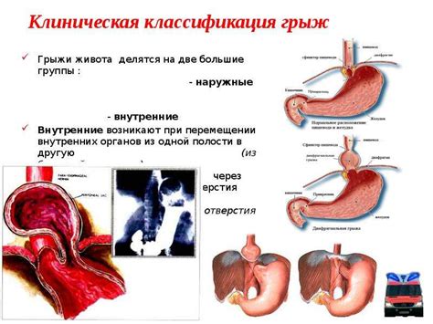 Симптомы перфорации желудочно-кишечного тракта