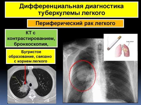 Симптомы плотных очагов