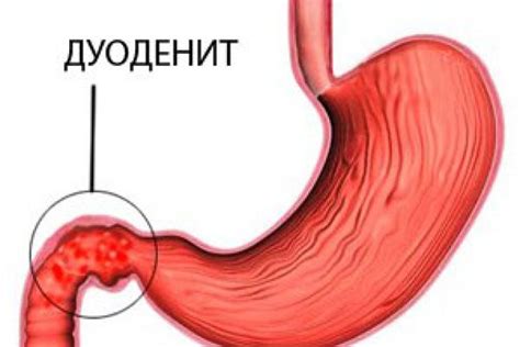 Симптомы поверхностного дуоденита