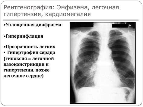 Симптомы повышенной пневматизации легких