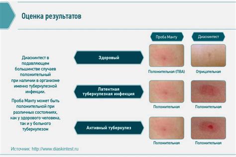 Симптомы положительного теста манту