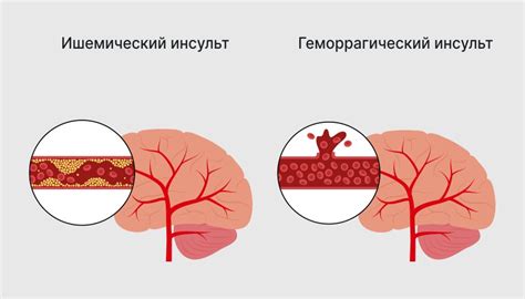 Симптомы польщения: как распознать его