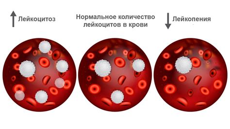 Симптомы пониженных лейкоцитов