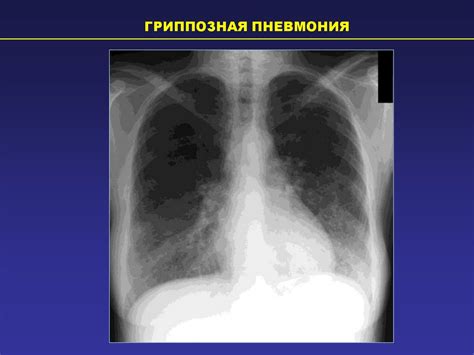 Симптомы поствоспалительных изменений легких