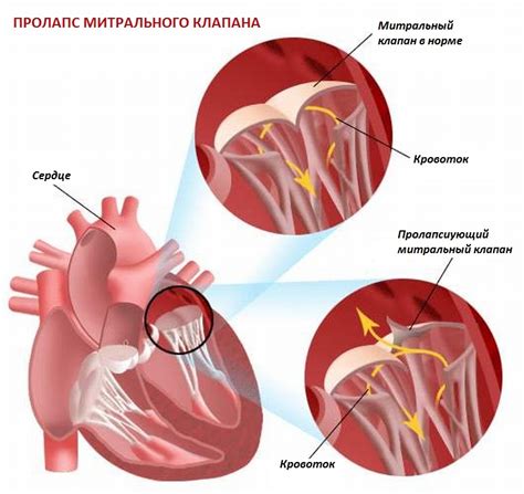 Симптомы прижатого клапана