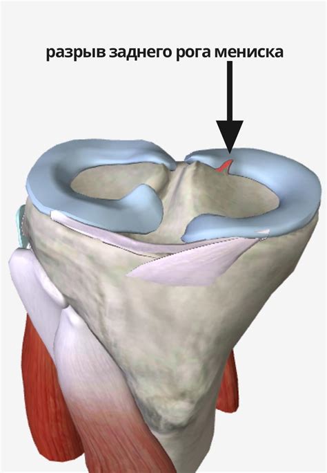 Симптомы пролабации мениска