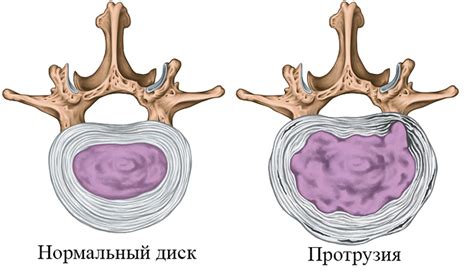 Симптомы протрузии позвоночных дисков