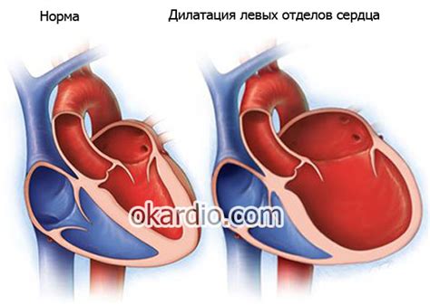 Симптомы расширения полостей сердца