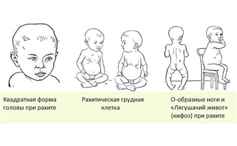 Симптомы рахита 2 степени