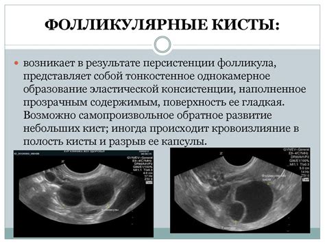 Симптомы ремнантных кист гиппокампов