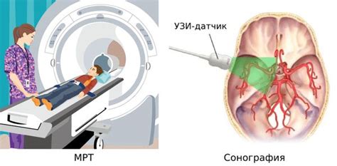 Симптомы ретроцеребеллярной кисты головного мозга